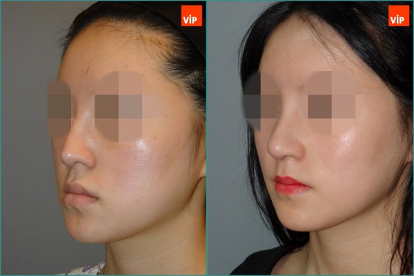 Nose Surgery - Rib cartilage rhinoplasty