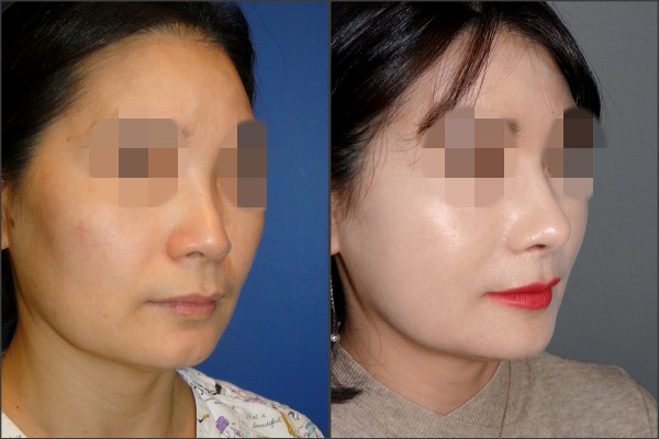 Nose Surgery - Rib cartilage rhinoplasty