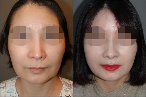 Nose Surgery - Rib cartilage rhinoplasty