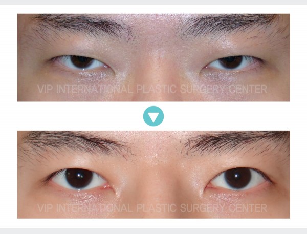 Eye Surgery - Male eyelid surgery