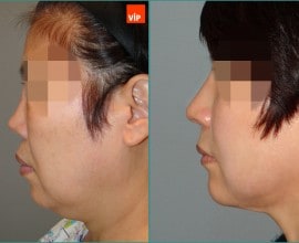 Rib Cartilage Rhinoplasty, Facelift