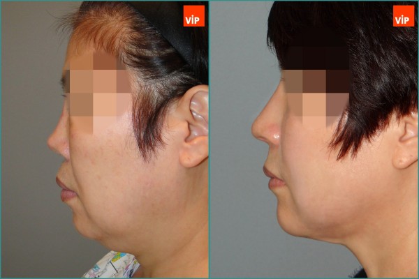 Nose Surgery, Face Lift - Rib Cartilage Rhinoplasty, Facelift