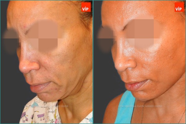 Face Lift - Facelift, Necklift