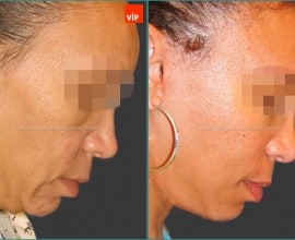 Facelift, Necklift