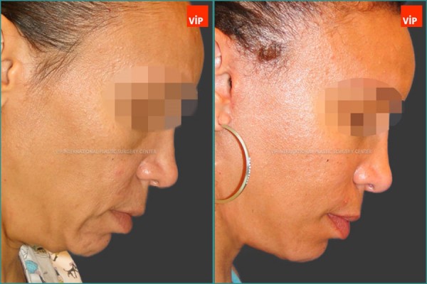 Face Lift - Facelift, Necklift