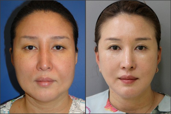 Nose Surgery, Eye Surgery, Face Lift - Facelift, Combination Rhinoplasty, Eyelid Surgery