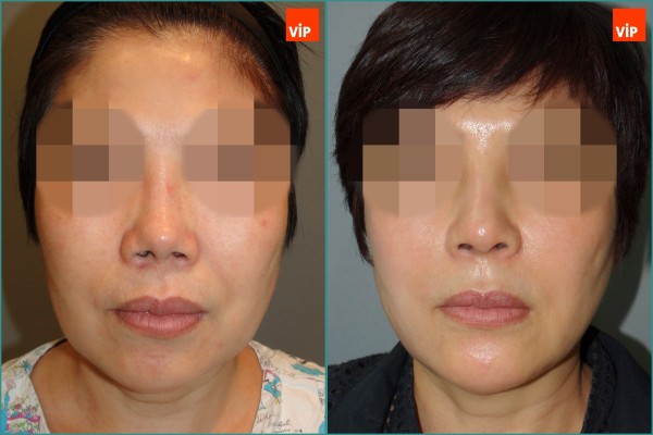 Nose Surgery, Face Lift - Rib Cartilage Rhinoplasty, Facelift