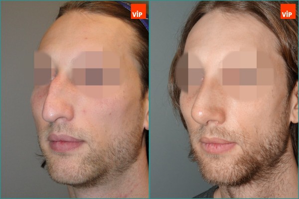 Nose Surgery - Septal cartilage rhinoplasty, Hump Nose