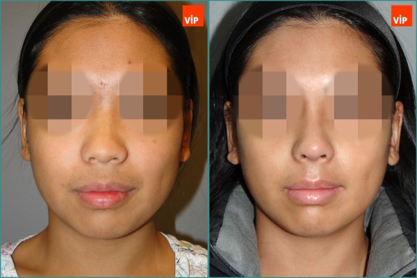 Nose Surgery - Rib cartilage rhinoplasty