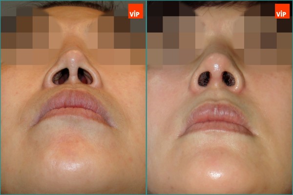 Nose Surgery, Face Lift - Rib Cartilage Rhinoplasty, Facelift