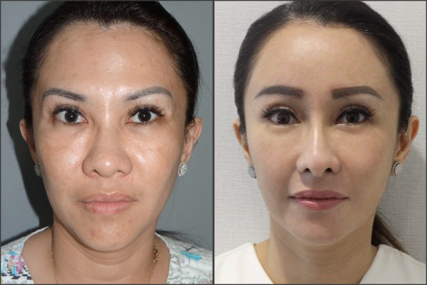 Nose Surgery, Eye Surgery, Face Lift, Fat graft - Rib cartilage Rhinoplasty, Endoscopic Forehead Lift, Fat graft, Lateral Canthoplasty