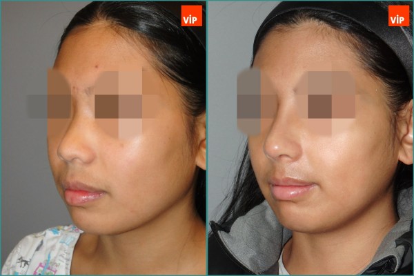 Nose Surgery - Rib cartilage rhinoplasty