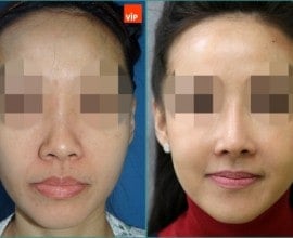 Combination Rhinoplasty, Fat Graft