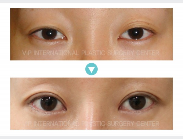 Eye Surgery - Ptosis Correction