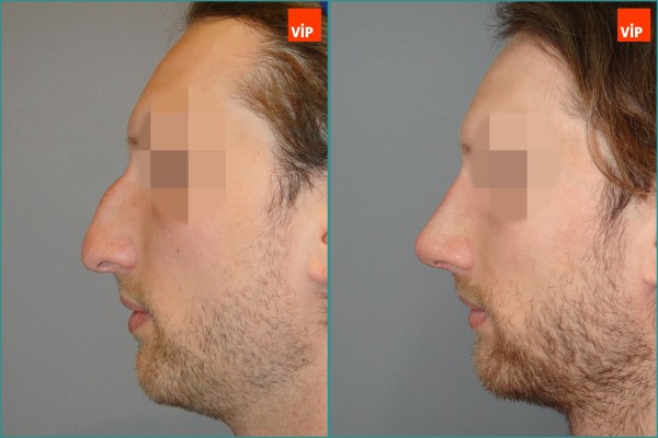 Nose Surgery - Septal cartilage rhinoplasty, Hump Nose