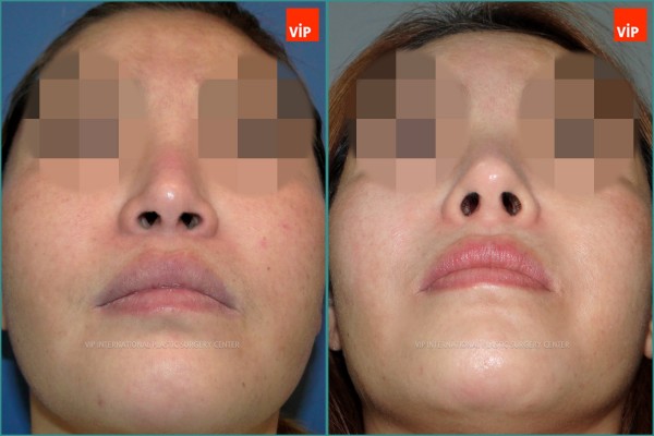 Nose Surgery - Rib cartilage rhinoplasty