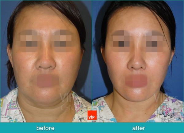 Face Lift - High SMAS Face / Necklift, Lipolysis