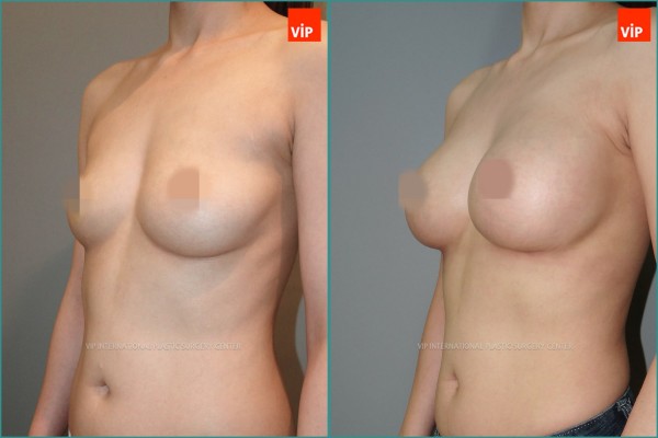 Breast Surgery - Breast Surgery