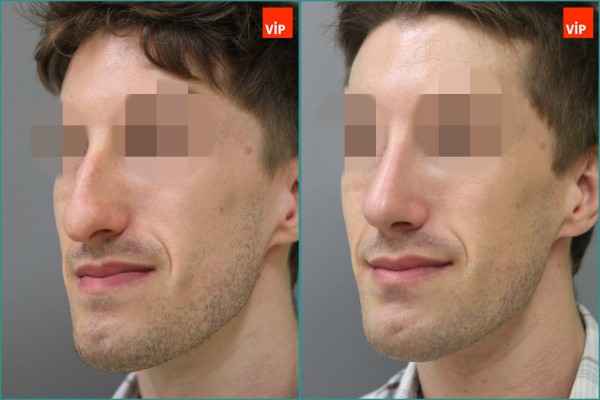 Nose Surgery - Septal cartilage rhinoplasty, Hump nose Surgery