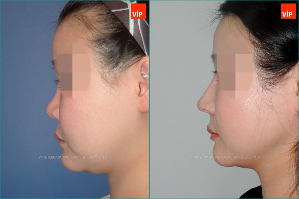 Nose Surgery - Rib cartilage rhinoplasty, Mid face augmentation