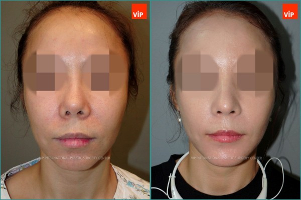 Nose Surgery - Rib cartilage rhinoplasty