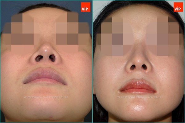 Nose Surgery - Rib cartilage rhinoplasty, Mid face augmentation