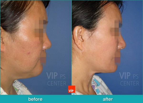 Face Lift - High SMAS Face / Necklift, Lipolysis