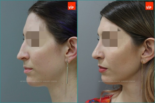 Nose Surgery - Septal cartilage rhinoplasty, Septal Deviation