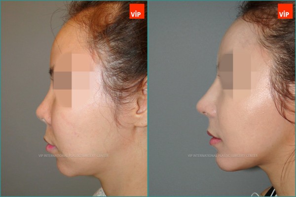 Nose Surgery - Rib cartilage rhinoplasty