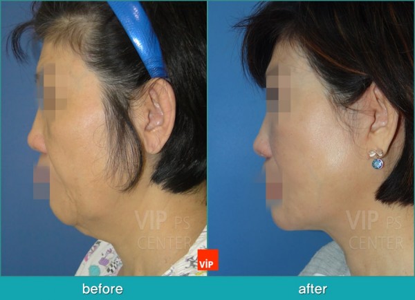 Face Lift - High SMAS Face / Necklift