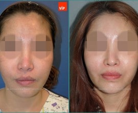 Rib cartilage rhinoplasty