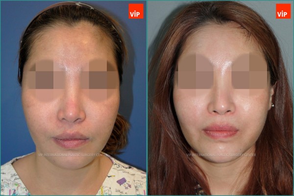 Nose Surgery - Rib cartilage rhinoplasty