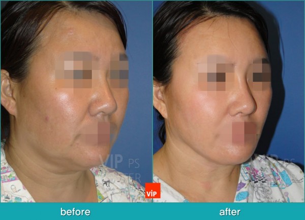 Face Lift - High SMAS Face / Necklift, Lipolysis