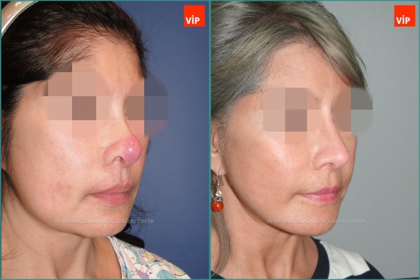 Nose Surgery - Face lift / Revision rhinoplasty / Rib cartilage rhinoplasty