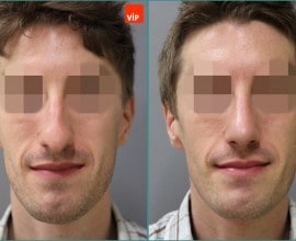 Septal cartilage rhinoplasty, Hump nose Surgery