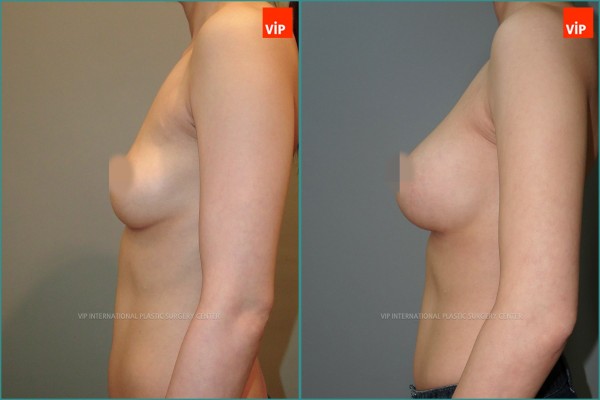 Breast Surgery - Breast Surgery