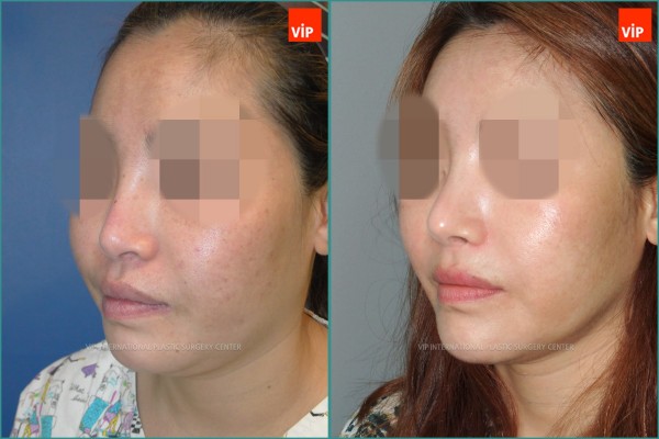 Nose Surgery - Rib cartilage rhinoplasty