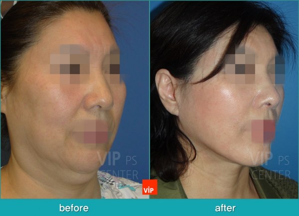 Face Lift - High SMAS Face / Necklift