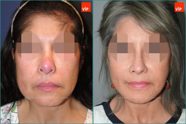 Nose Surgery - Face lift / Revision rhinoplasty / Rib cartilage rhinoplasty
