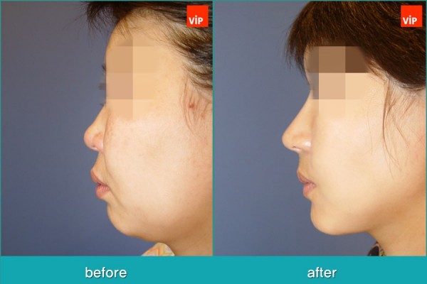 	Nose Surgery, Rib cartilage Rhinoplasty, Facial Bone Surgery, Fat graft	 - Rib Cartilage Rhinoplasty, Face Contouring Surgery, V-line Surgery, Fat Graft, Cheekbone Reduction