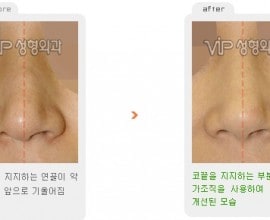 Revision rhinoplasty - Droopy tip