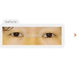 Incision double eyelid surgery