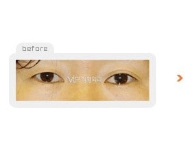 Incision double eyelid surgery