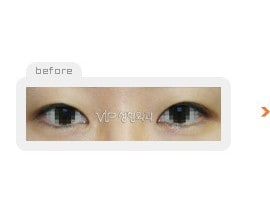 Non-incision double eyelid surgery