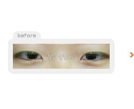 Non-incision double eyelid surgery