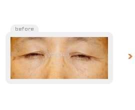 Upper & Lower blepharoplasty