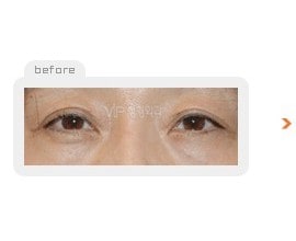 Upper & Lower blepharoplasty