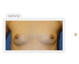 Breast augmentation