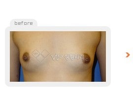 Breast augmentation