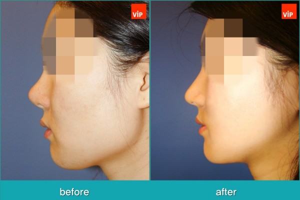 	Nose Surgery, Rib cartilage Rhinoplasty, Facial Bone Surgery	 - Face Contouring Surgery, V-line Jaw Reduction, Harmony Rhinoplasty using Rib Cartilage